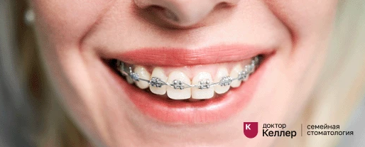 Металлические брекеты в клинике Доктор Келлер 